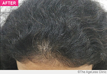 AGELESS MICROGRAFT HAIR TREATMENT™
